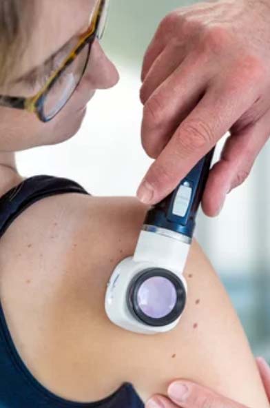 A dermatoscope is placed against the skin of a female patient to examine and diagnose skin lesions and diseases, such as melanoma.